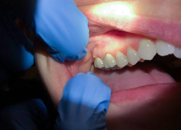 Best Knocked-Out Tooth Emergency  in Osceola Mills, PA
